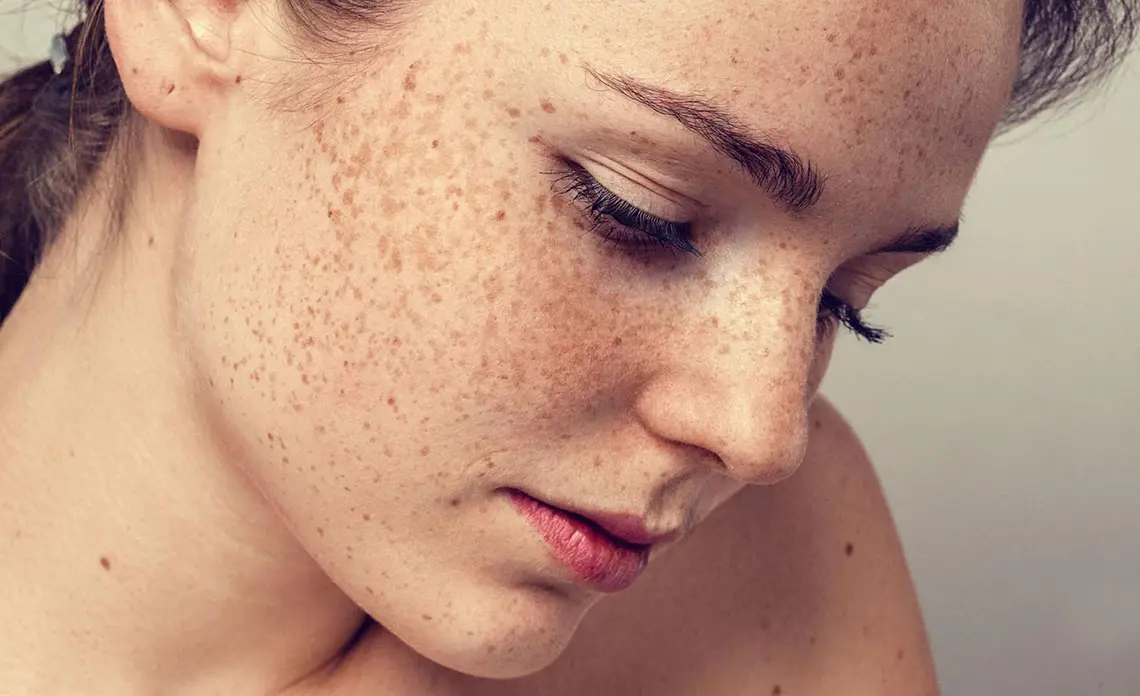 Sạm nám là khi làn da xuất hiện nhiều sắc tố đen hoặc nâu